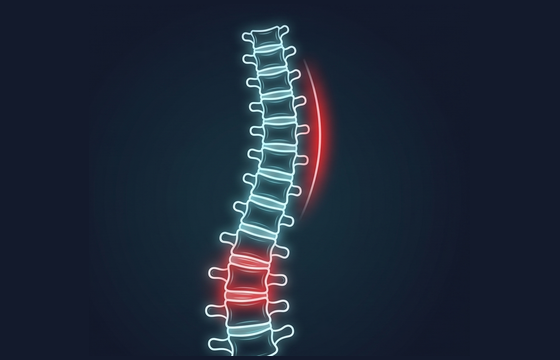 Neon illustration of a scoliosis curve of the spine