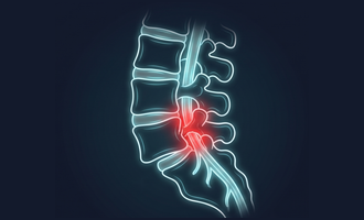 Neon illustration of a slipped vertebra