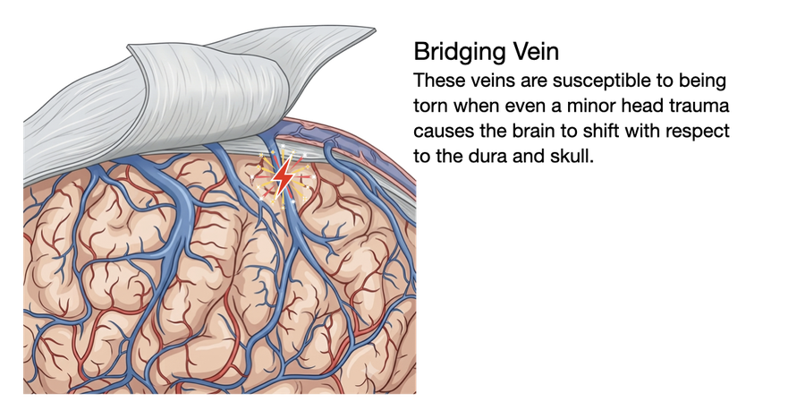The bridging vein shearing at the point where it crosses into the sinus.