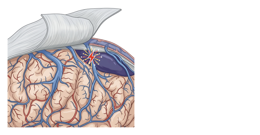 Blood beginning to collect in the subdural space at the site of the torn vein.